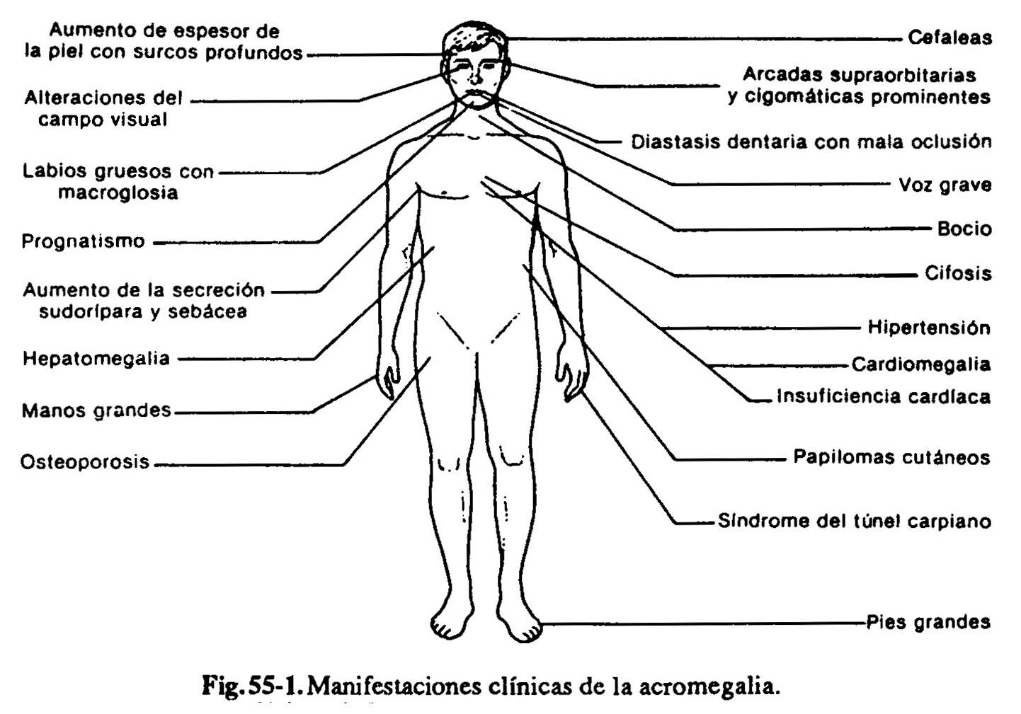 acrogigan01