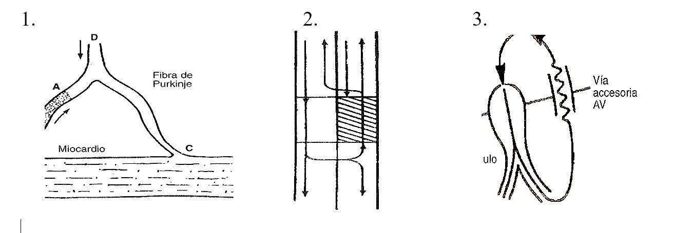 arrhythmia01