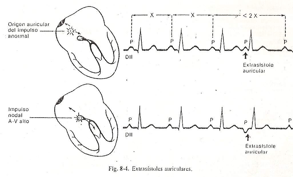 arritmia05