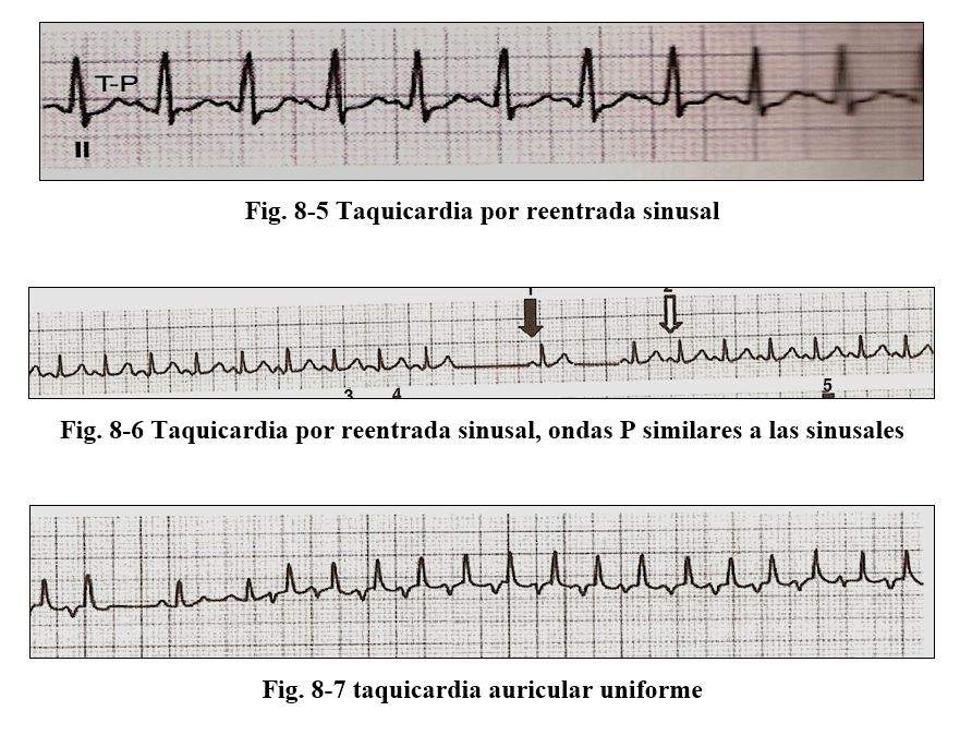 arritmia06