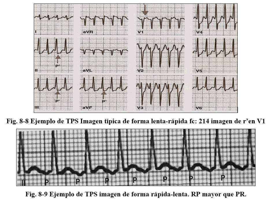 arrhythmia07