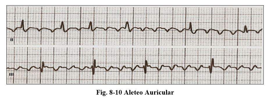 arrhythmia08