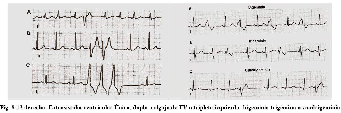 arrhythmia12