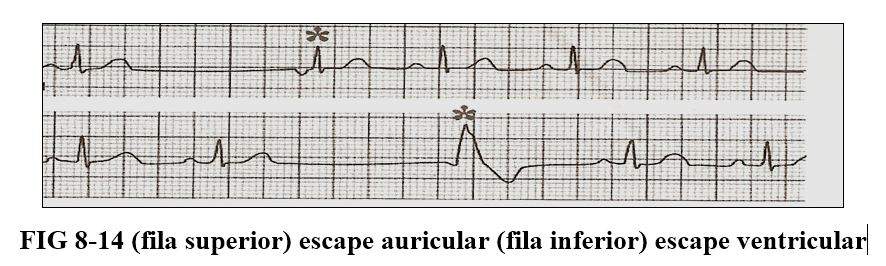 arrhythmia13