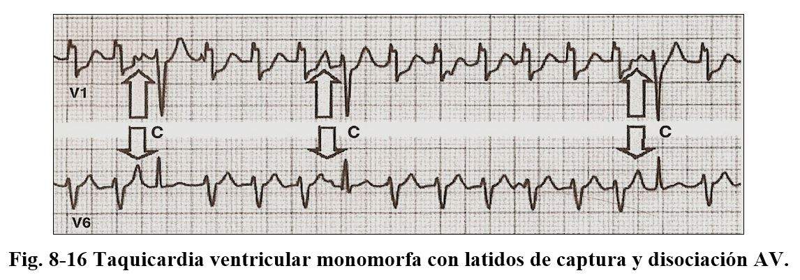 arritmia15