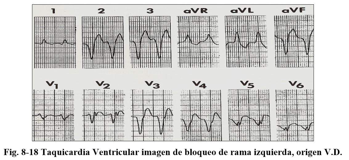 arritmia 17