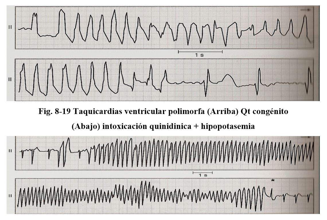 arritmia18