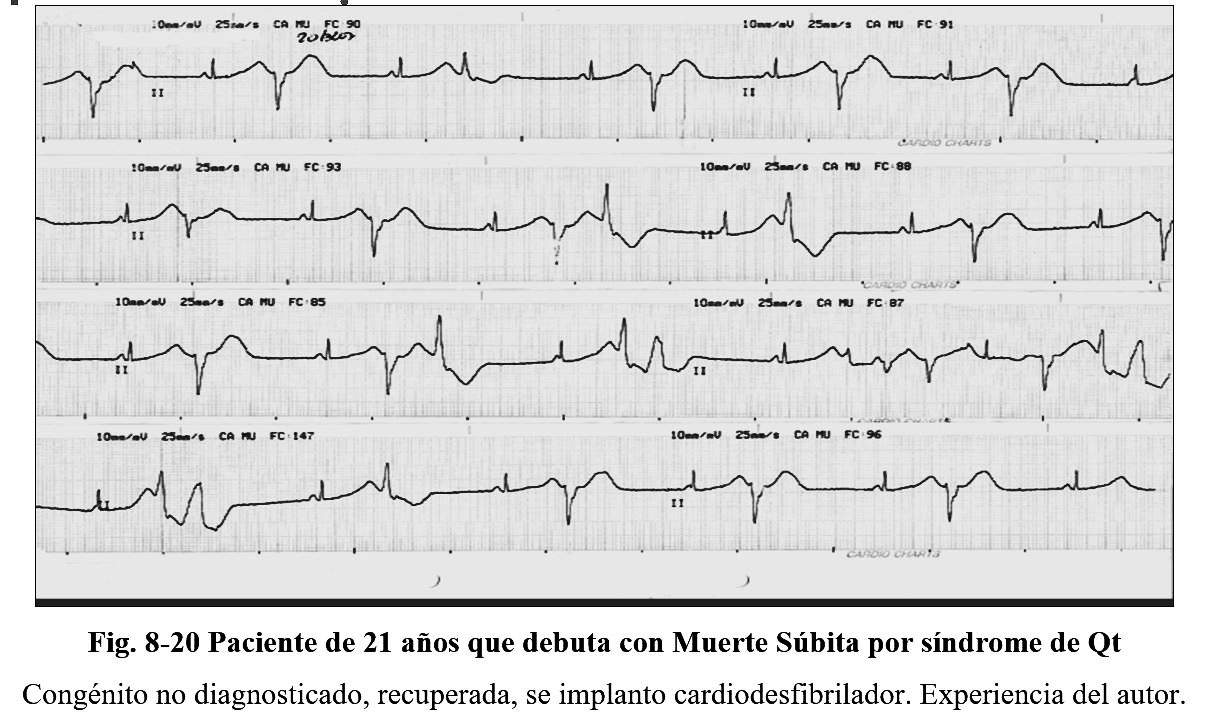 arritmia 19