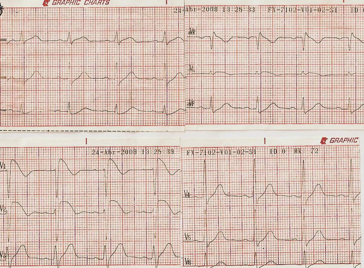 arrhythmia21