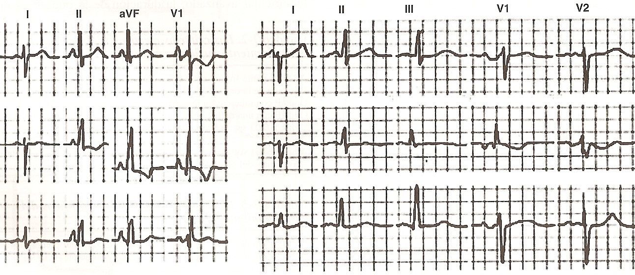 ecg14