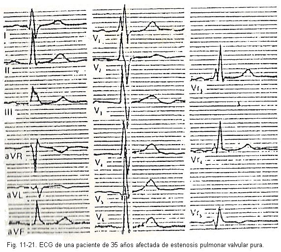 ecg20