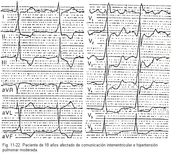 ecg21