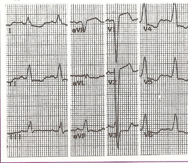 ecg25