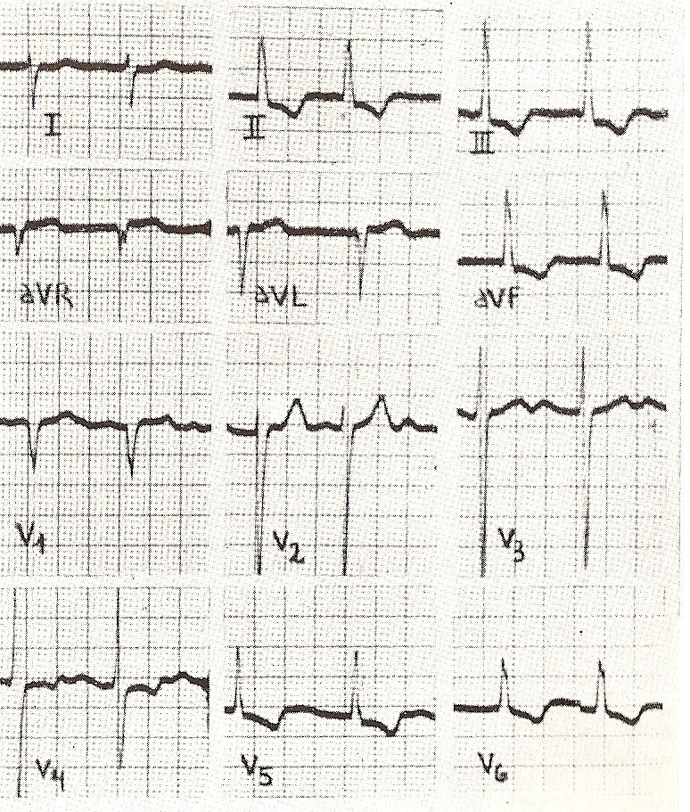 ecg27