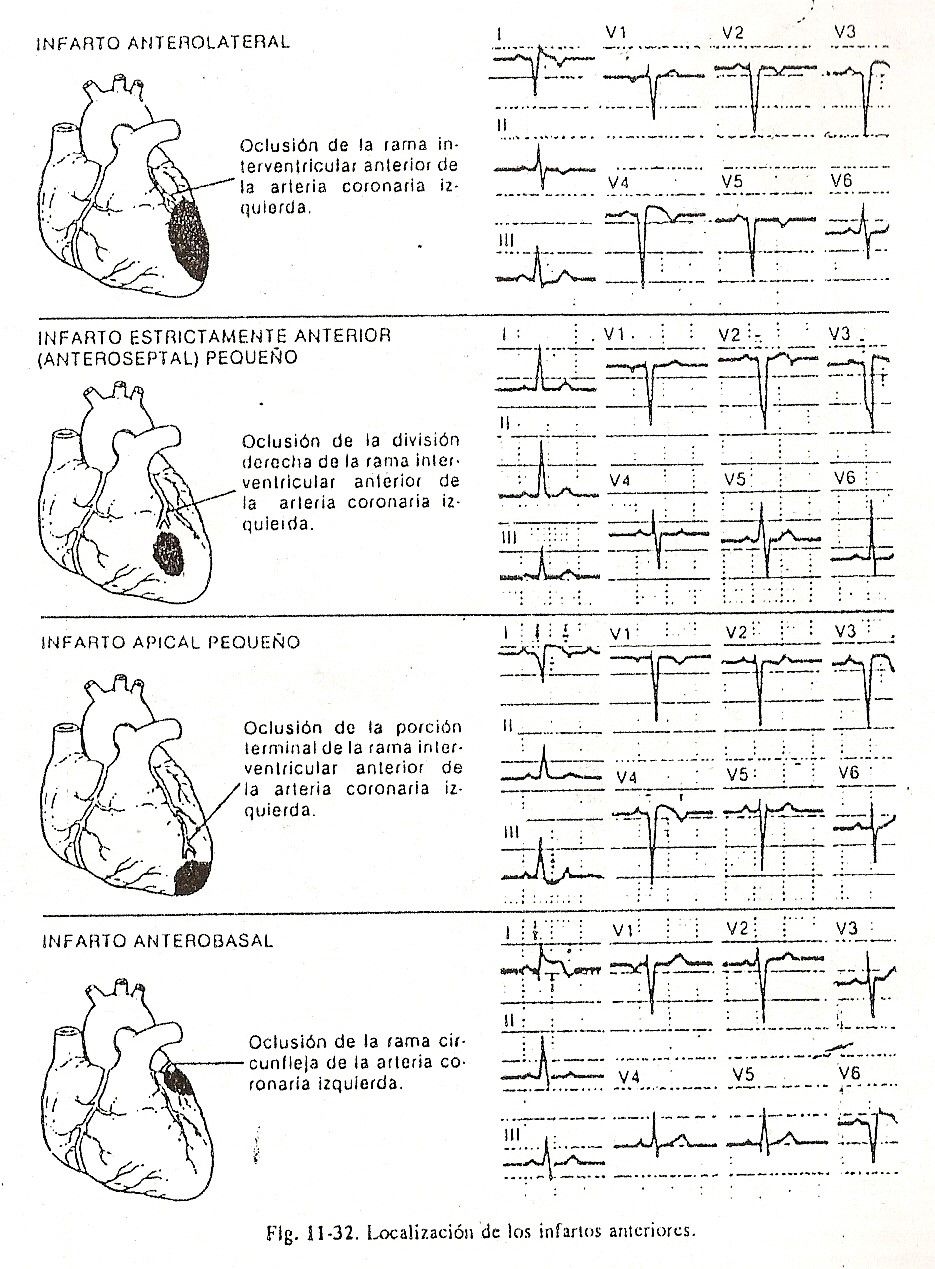 ecg31