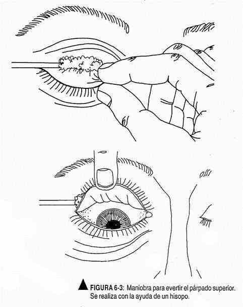 excabeza03