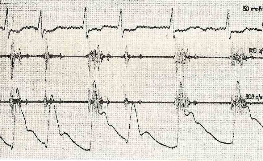 myocardium2