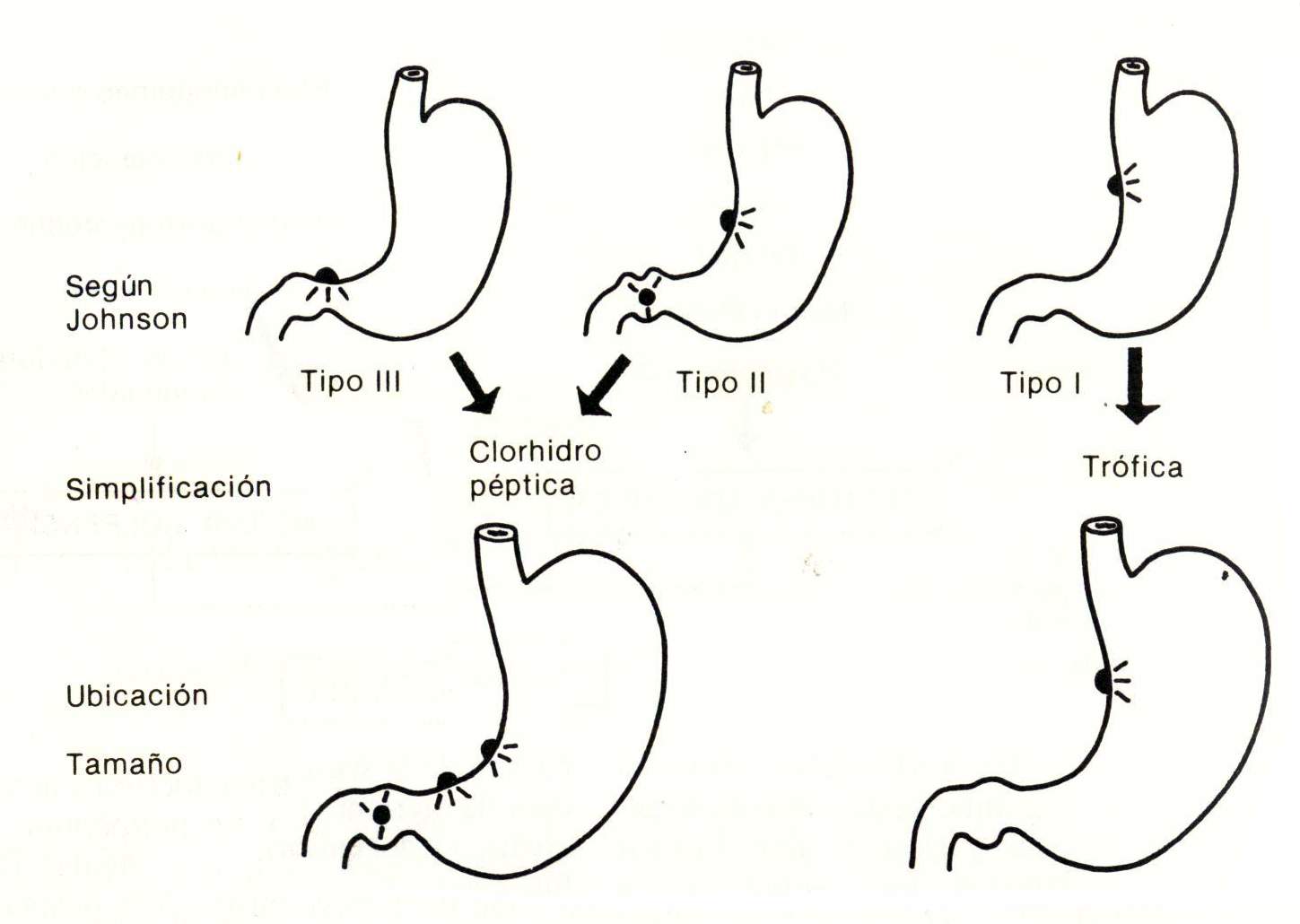 Úlcera gastroduodenal