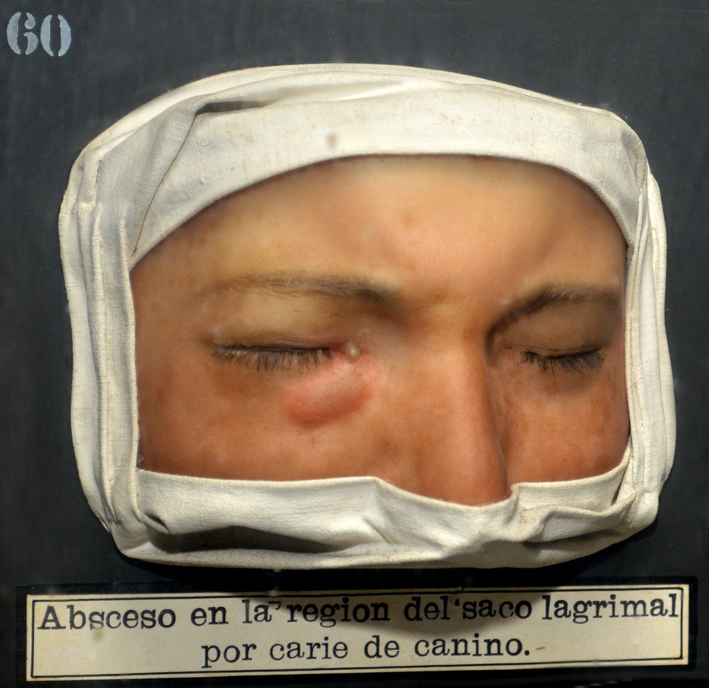 absceso_lagrimal
