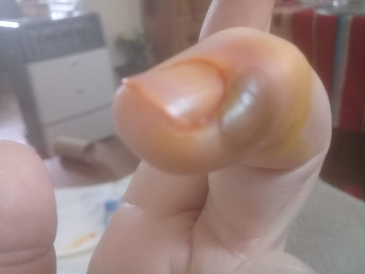 abscesoparaungeal