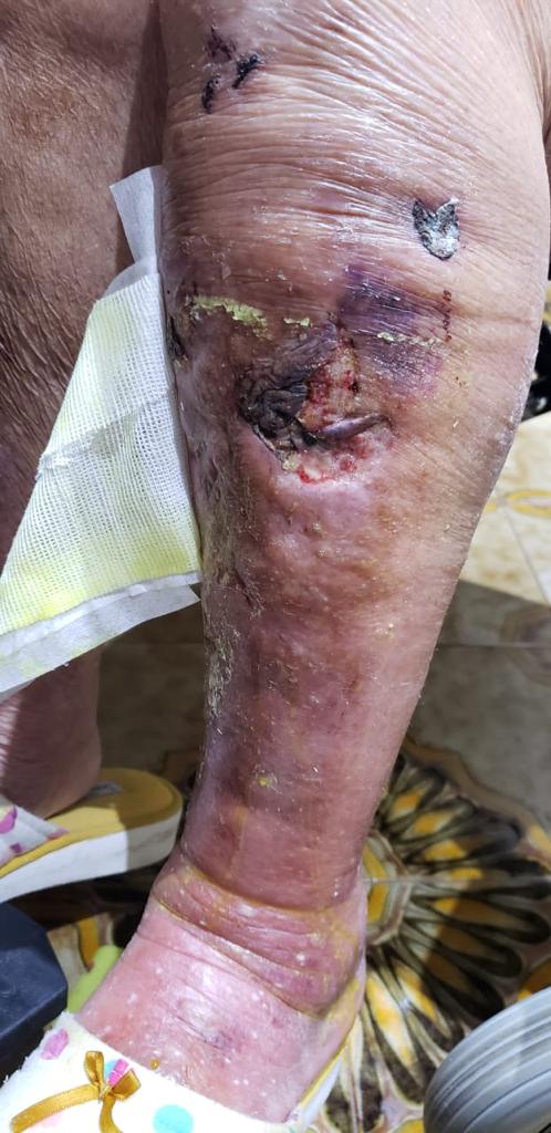 celulitis02