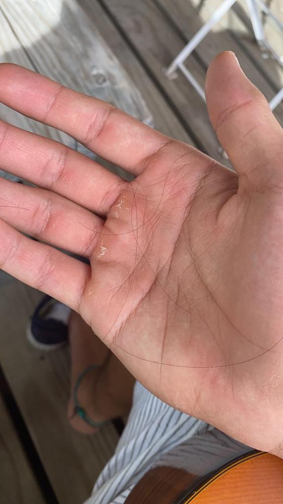 deshidrosis