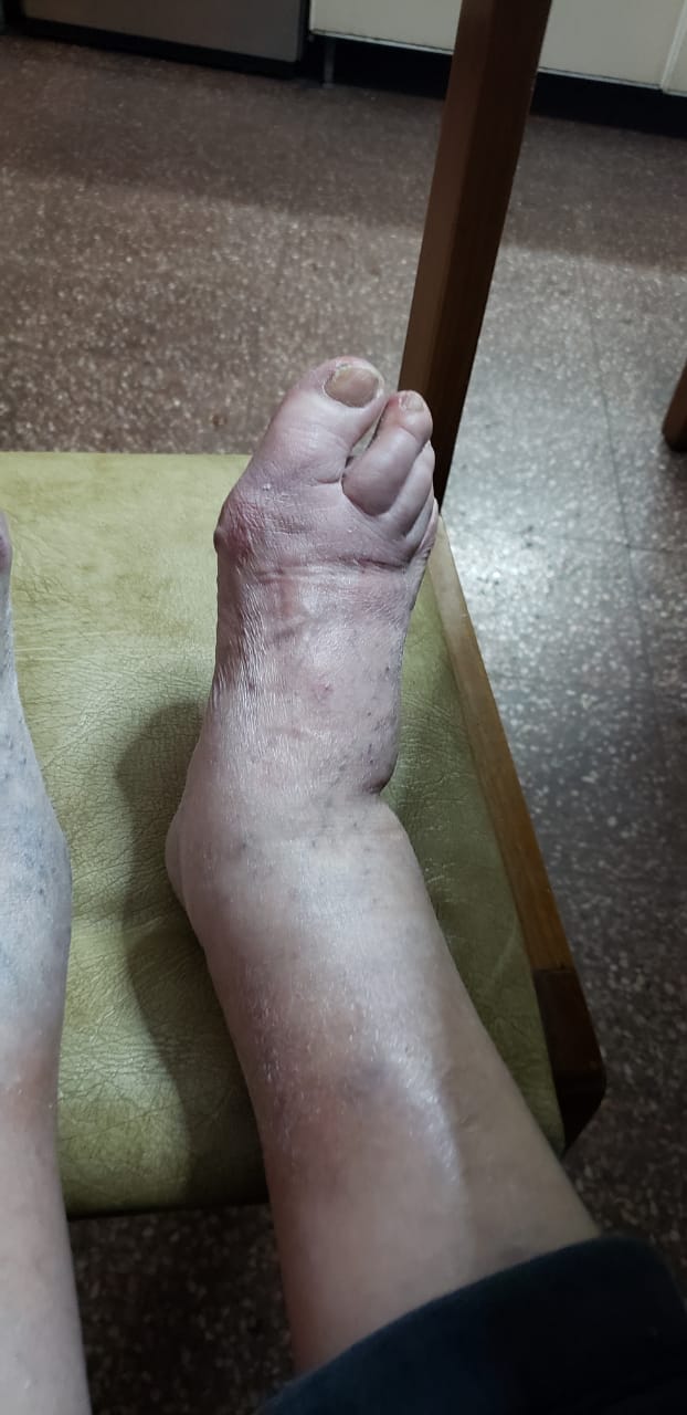 Edema unilateral