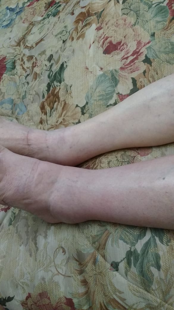 Edema unilateral