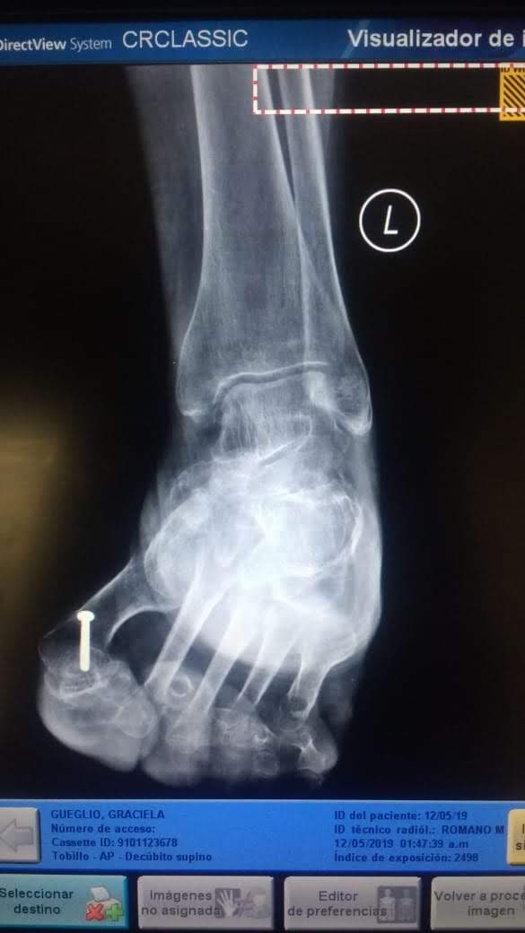 Fractura astragalina