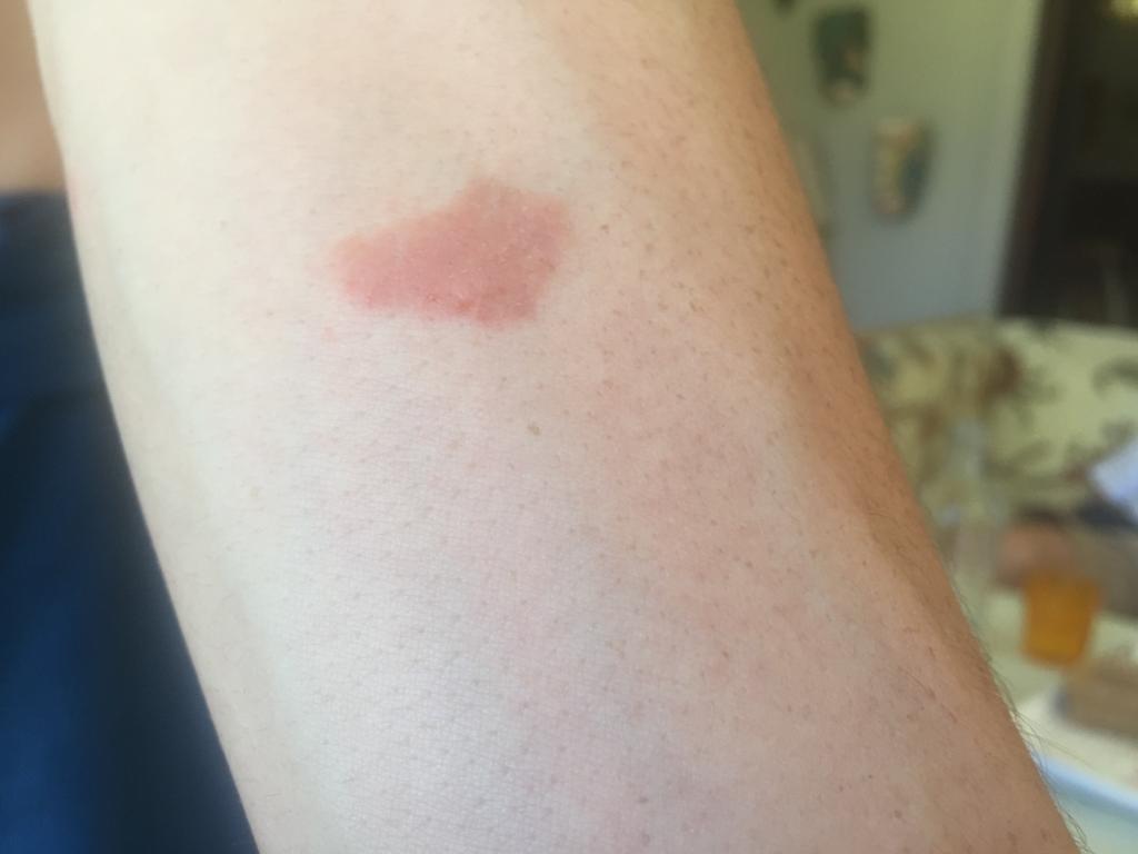 herpes