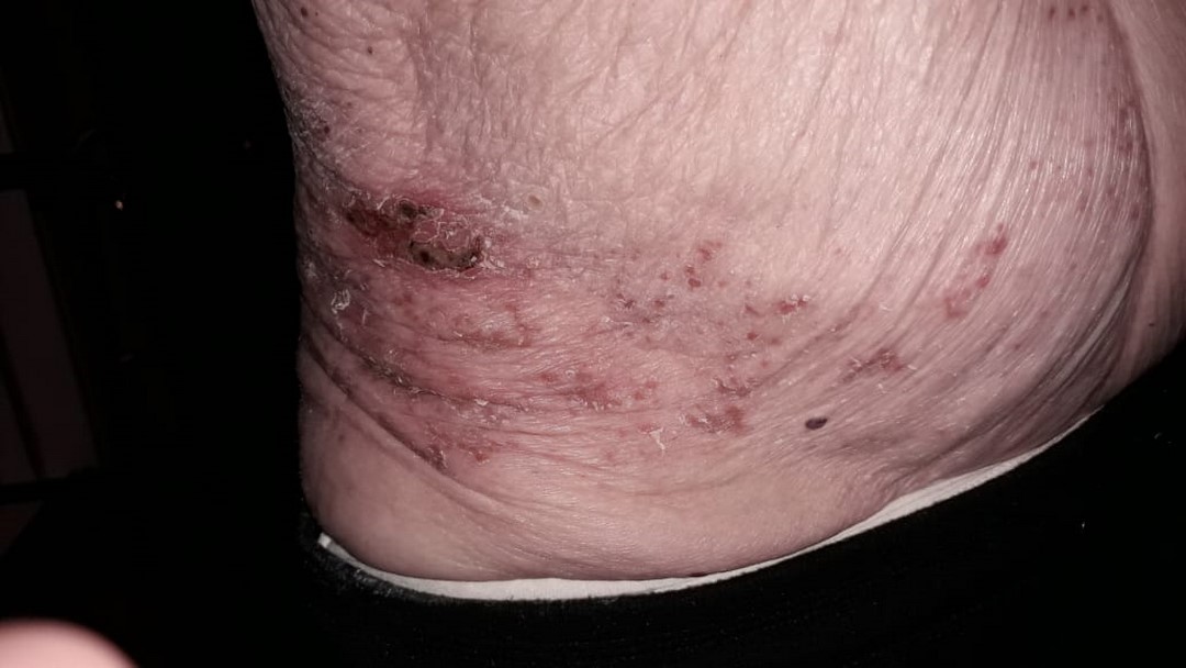 herpeszoster5