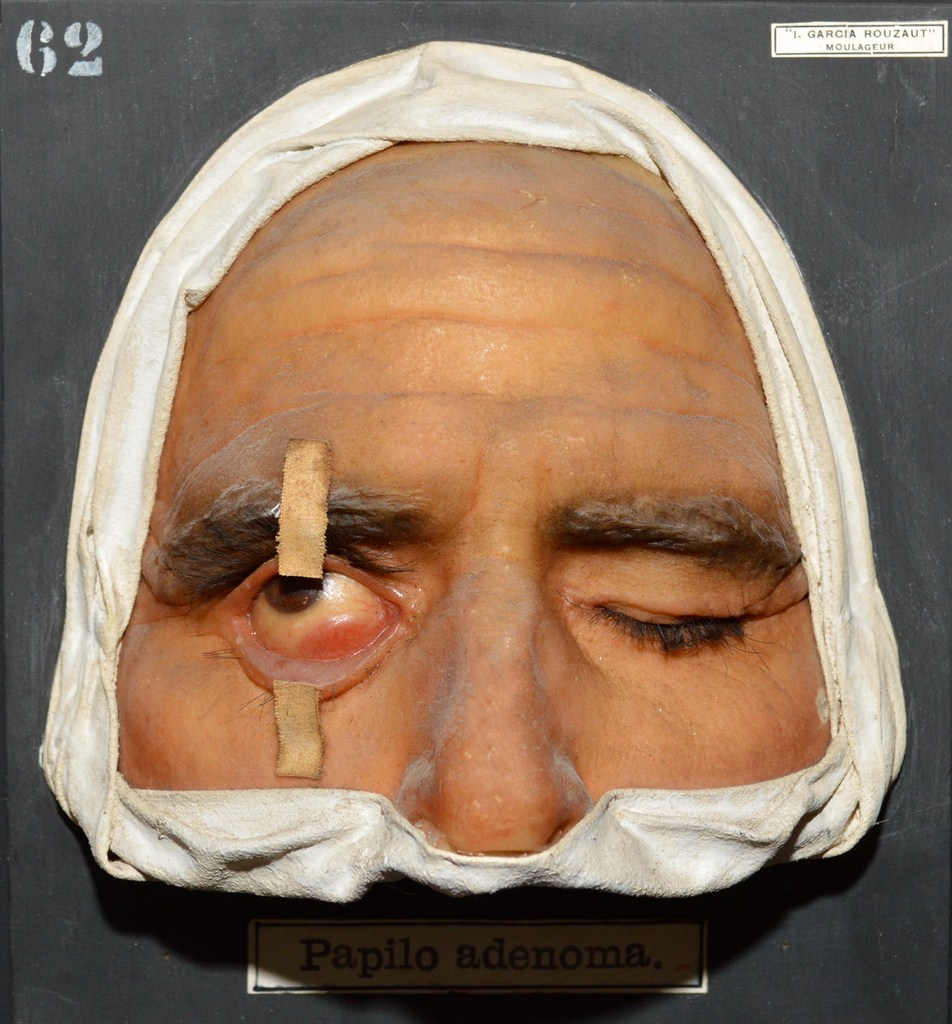 papiloadenoma