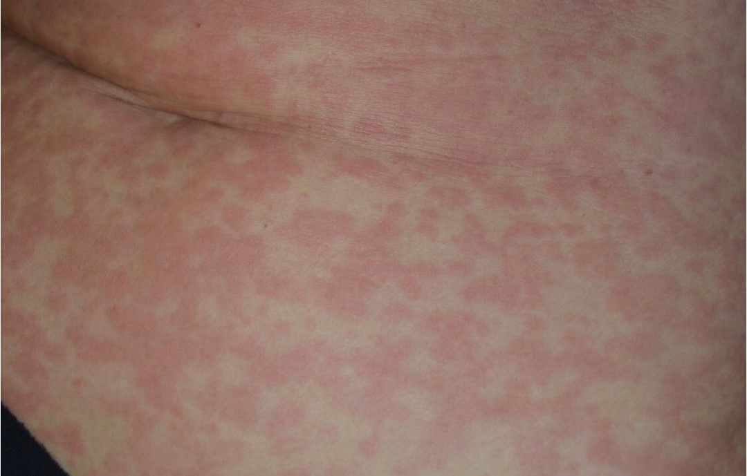 reaccioncoronavirus3