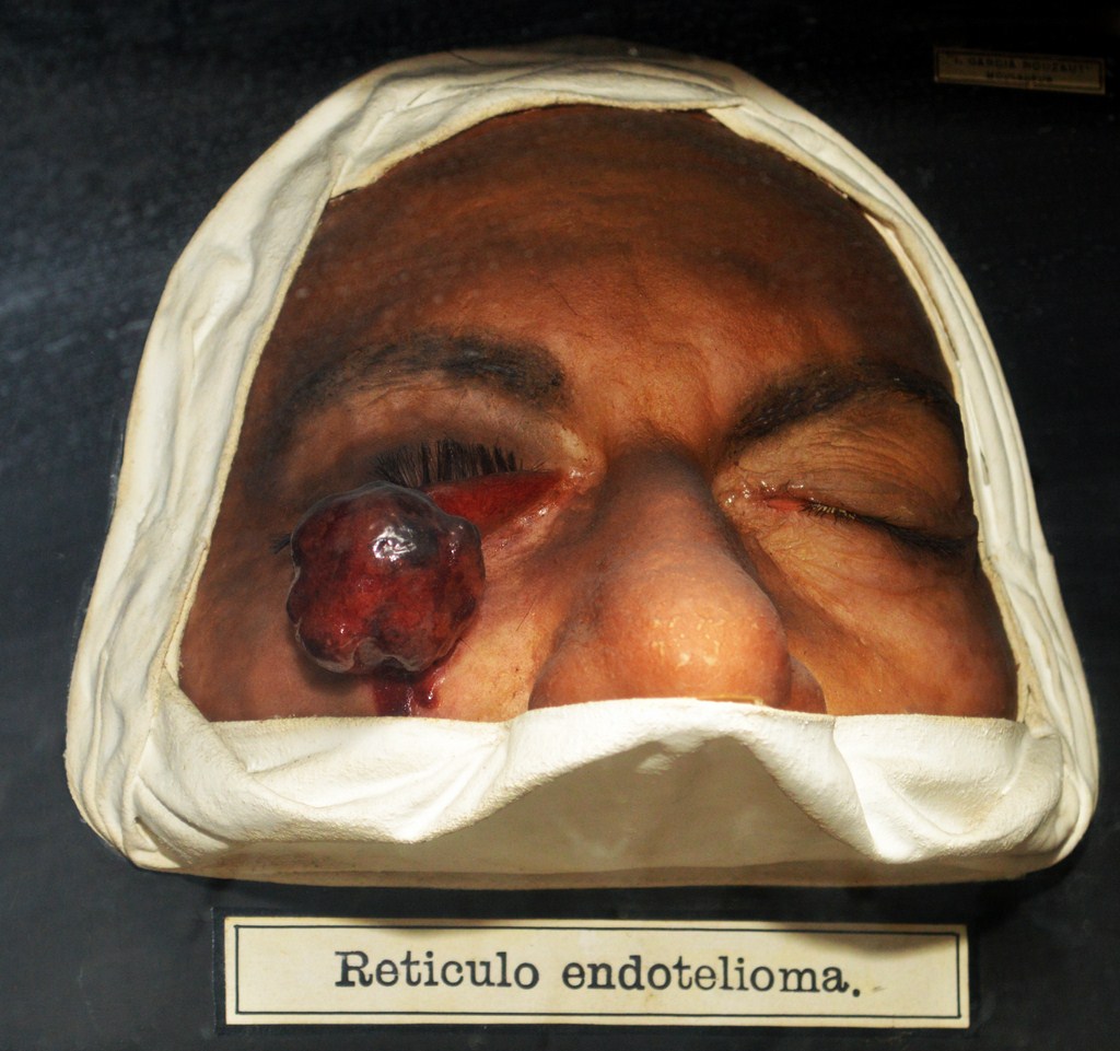 reticulo_endotelioma