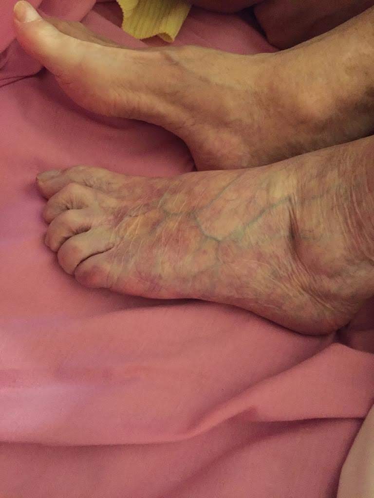 Trombosis arterial evolución