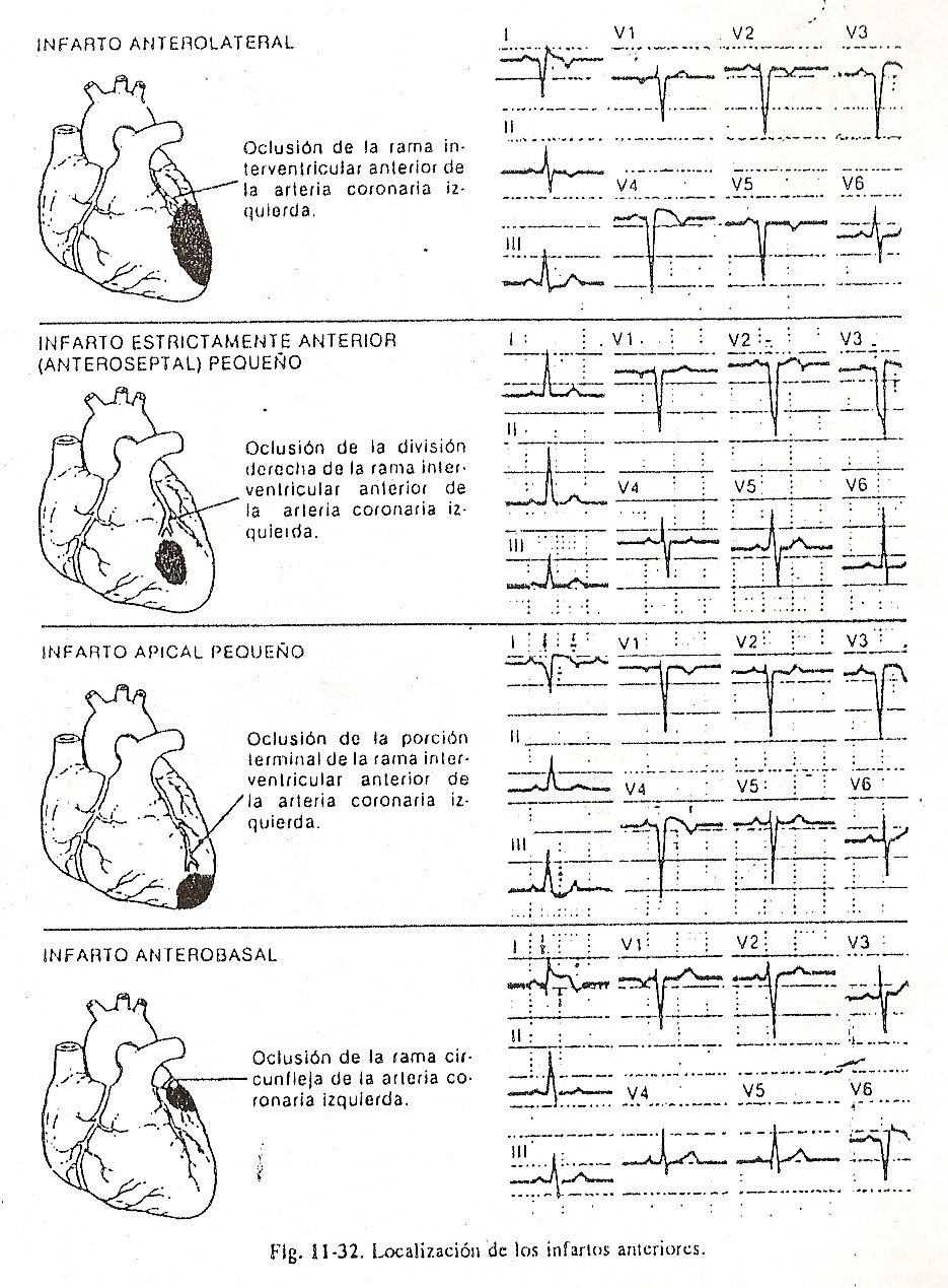ecg31