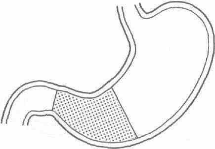 gastritis04